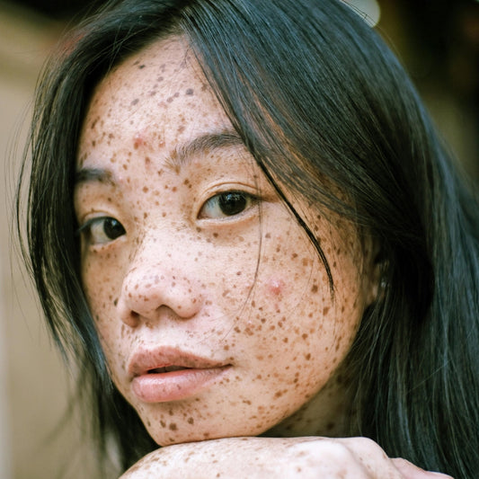 Hyperpigmentation: What is it and how to address it